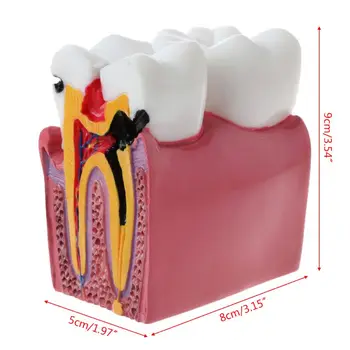 6 Моделей Анатомических Зубов для Сравнения Кариеса для Лаборатории Стоматологической Анатомии Tea Dropship - Изображение 1  