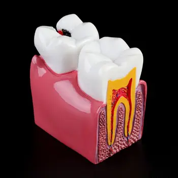 6 Моделей Анатомических Зубов для Сравнения Кариеса для Лаборатории Стоматологической Анатомии Tea Dropship - Изображение 2  
